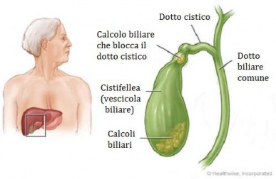 Come riconoscere i calcoli alla cistifellea
