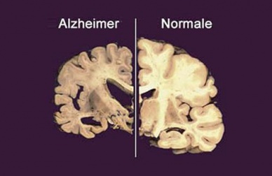 Insonnia e Alzheimer, esiste un collegamento?