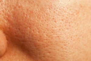 Come chiudere i pori in modo naturale