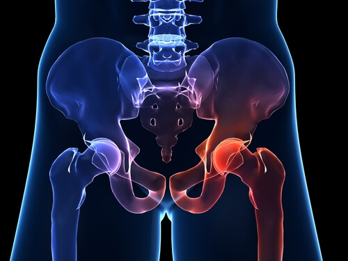 Artrosi dell’anca: sintomi e prevenzione