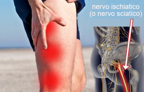 Alleviare la sciatica con rimedi naturali