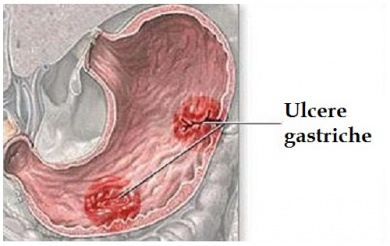Sintomi di un'ulcera gastrica