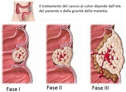 Cosa bisogna sapere sul tumore al colon