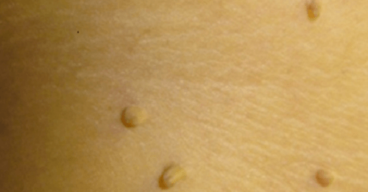 10 rimedi naturali per eliminare le verruche sul corpo