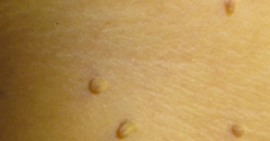 10 rimedi naturali per eliminare le verruche sul corpo