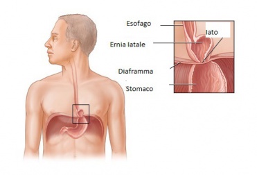 Curare l'ernia iatale: è possibile?