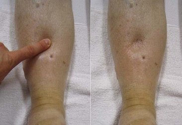 Idropisia: tipologie, cause e sintomi