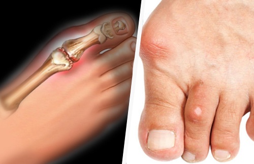 accumulo di acido urico nel piede