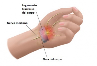Alleviare il dolore della sindrome del tunnel carpale