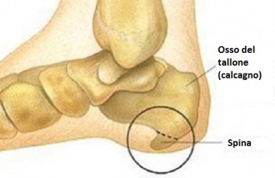 Spina calcaneare: sintomi e trattamento del disturbo