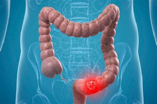 tumore al colon retto