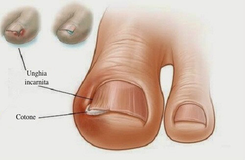 Rimedio naturale per le unghie incarnite del piede