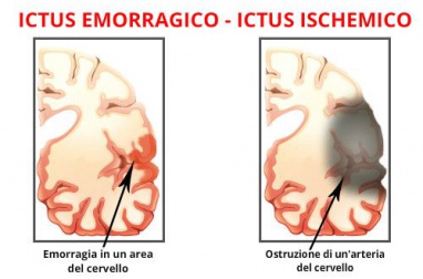 Ictus
