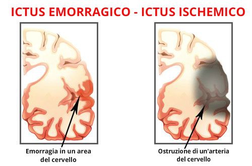 conseguenze non dormire ictus