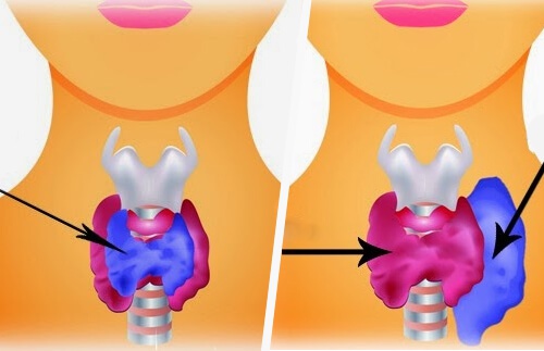 esempio di ipertiroidimo