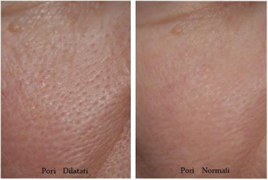 Trattare i pori dilatati: 3 maschere per attenuarne l'aspetto