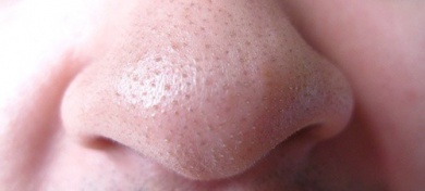 Tè verde per combattere acne e punti neri
