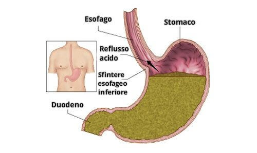 Reflusso gastrico