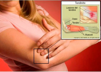Infiammazione dei tendini: come alleviare i sintomi
