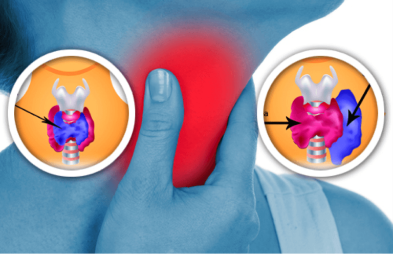 Come individuare in tempo le anomalie della tiroide