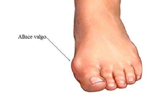 trattare l'alluce valgo