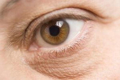 effetti negativi dello stress sugli occhi