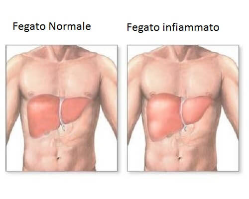 Sintomi Del Fegato Infiammato E Dieta Adeguata Vivere Più Sani