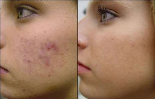 Maschere viso per l'acne da preparare in casa