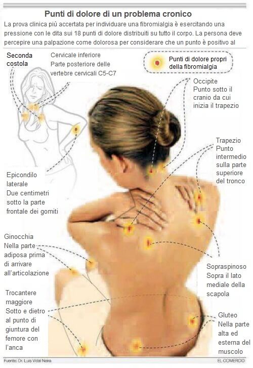 Punti sensibili della fibromialgia