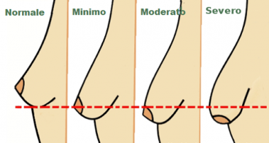 Seno cadente: 5 abitudini che causano il problema