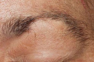 Alopecia di ciglia e sopracciglia: che rimedio bisogna usare?