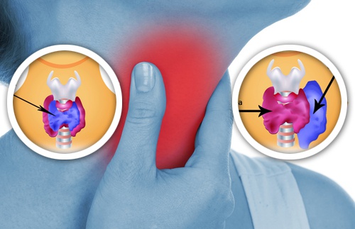 Anomalie della tiroide