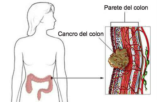 Cancro del colon-retto, ecco i sintomi da non trascurare