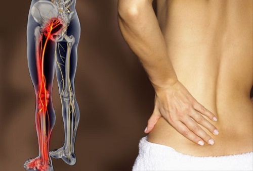 Dolore sciatica