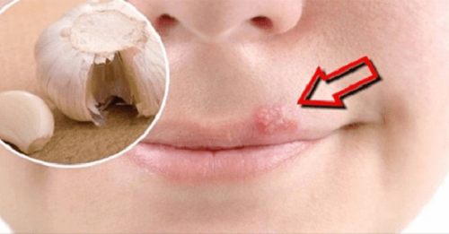 Alleviare l'herpes labiale con rimedi naturali