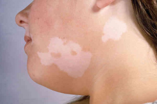 Vitiligine macchie bianche sulla pelle