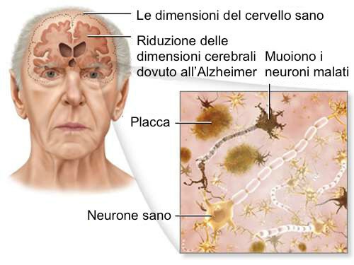 Morbo di Alzheimer