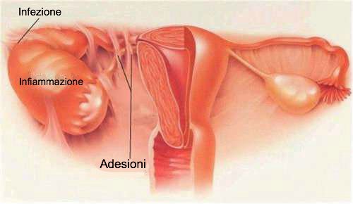 Malattia infiammatoria pelvica o PID