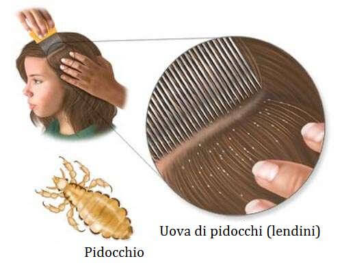 5 Rimedi Naturali Per Eliminare I Pidocchi Vivere Piu Sani