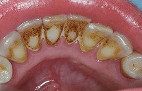 Placca: come eliminarla per migliorare la salute orale