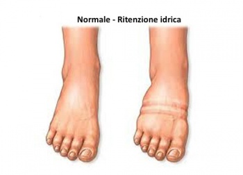 Ritenzione idrica