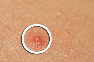 Consigli alimentari e rimedi naturali per l'acne