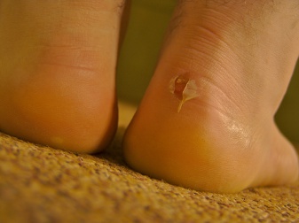 Come curare le vesciche e le lesioni sui piedi