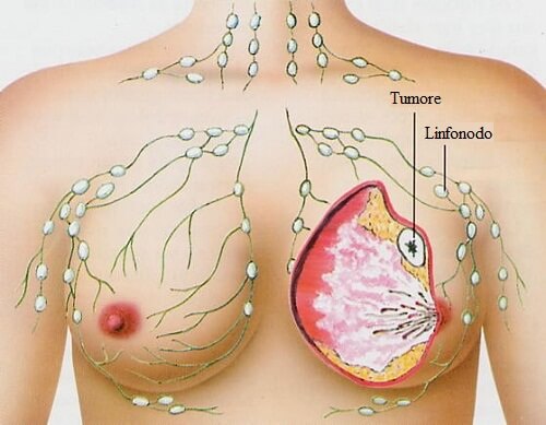 I tumori più diffusi tra le donne sono cinque