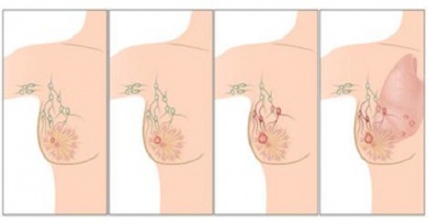 Principali cause del carcinoma mammario