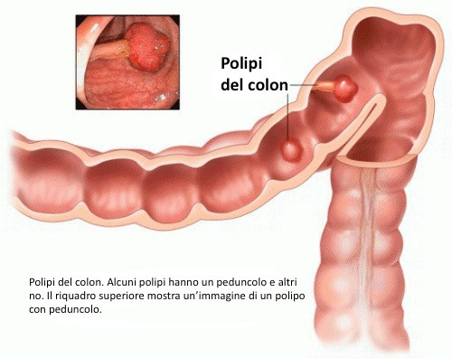 polipo-colon-500x396