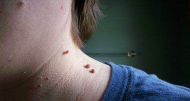Fibromi penduli: eliminarli con un solo ingrediente