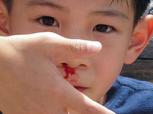 Bambino perde sangue al naso