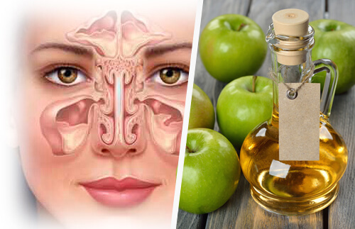 Seni paranasali e aceto di mele
