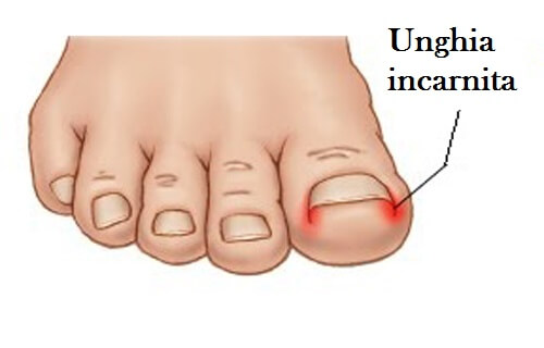 unghia incarnita